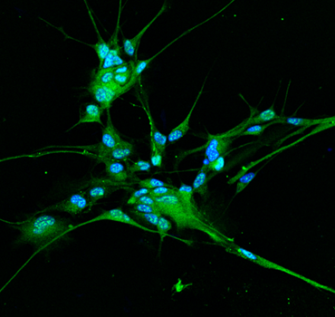 Glioblastoma: scoperto un meccanismo che aiuta le cellule tumorali a moltiplicarsi