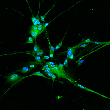 Glioblastoma: scoperto un meccanismo che aiuta le cellule tumorali a moltiplicarsi